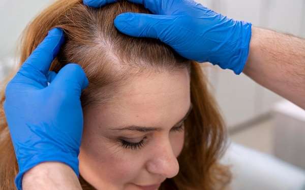 diagnosticar alopecia