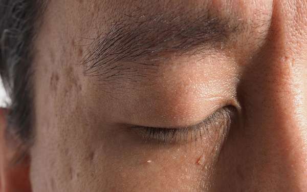 eliminar verrugas en los ojos
