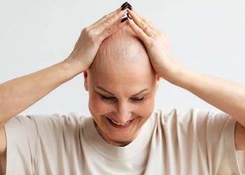 todo sobre la alopecia universal
