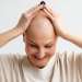 todo sobre la alopecia universal