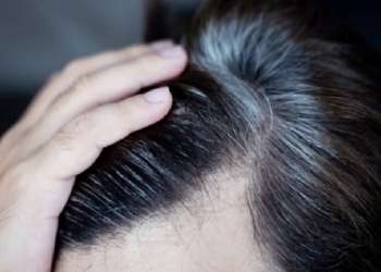 Poliosis
