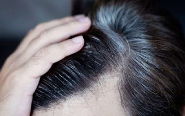 Poliosis