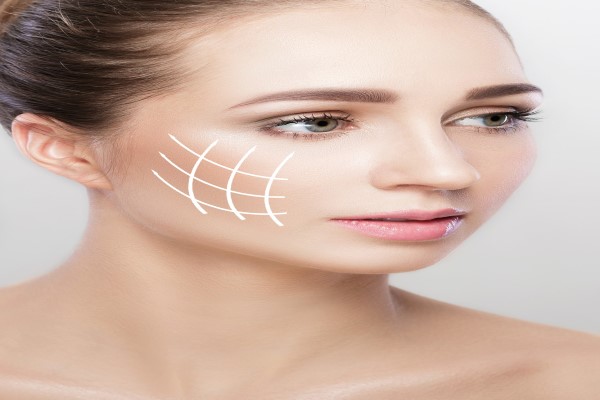 hilos tensores y Botox - mujer con el diseño de un tratamiento de hilos tensores superpuesto en su cara