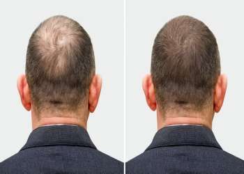 trasplante de pelo