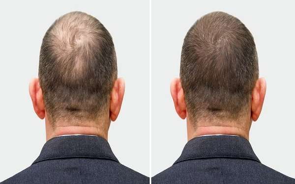 trasplante de pelo