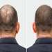 trasplante de pelo