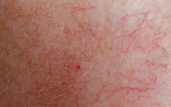 clínicas de tratamiento cuperosis en Barcelona