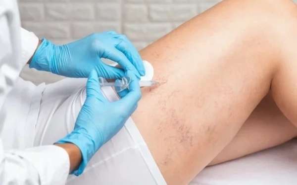 Las 3 mejores clínicas de escleroterapia en Barcelona