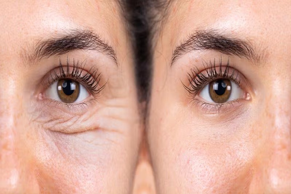 Tratamiento para el contorno de ojos