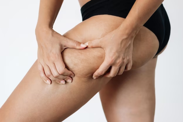 Celulitis edematosa