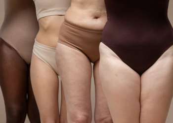 Celulitis edematosa