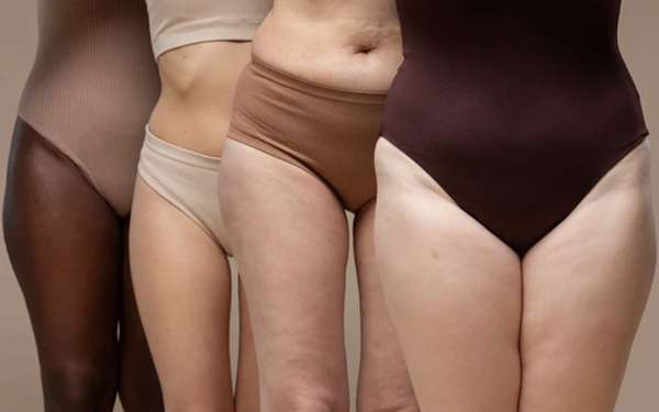 Celulitis edematosa