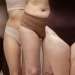 Celulitis edematosa, ¿de qué se trata? Celulitis edematosa