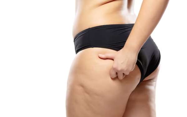 Tipos de celulitis