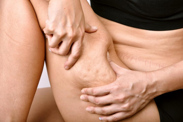 Tipos de celulitis