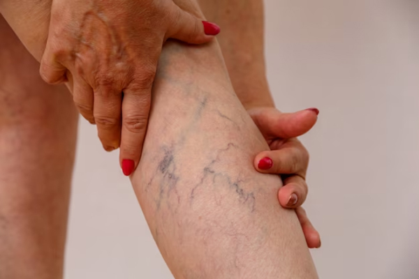 Celulitis edematosa