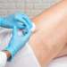 Escleroterapia - Mujer adulta recibiendo tratamiento inyectable para eliminar arañas vasculares de las piernas