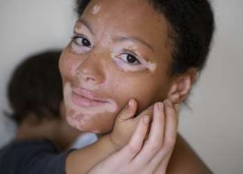 Tipos de manchas en la piel - Mujer con manchas en el rostro a causa del vitíligo cargando a su bebé