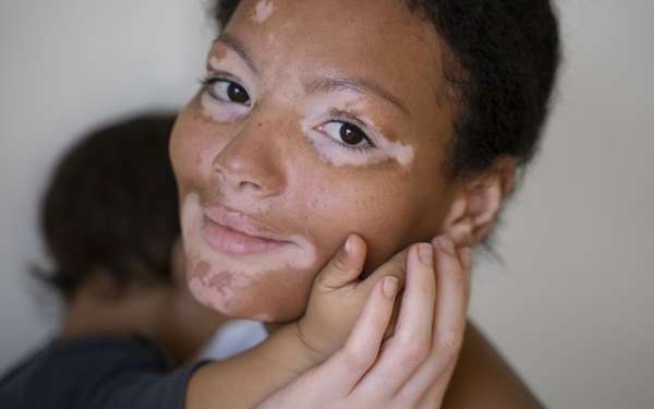 Tipos de manchas en la piel - Mujer con manchas en el rostro a causa del vitíligo cargando a su bebé