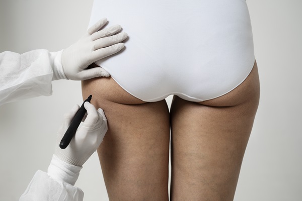 Ácido hialurónico en glúteos - Doctor usando un marcador para realizar el diseño de aumento de glúteos a una paciente femenina, utilizando el tratamiento de ácido hialurónico