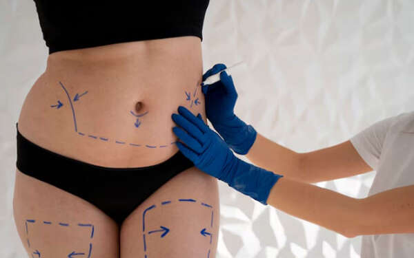 Abdominoplastia en Palma de Mallorca - Especialista en medicina estética delimita las áreas de grasa localizada que se removerán para modelar y tonificar el abdomen de una paciente