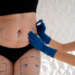 Abdominoplastia en Palma de Mallorca - Especialista en medicina estética delimita las áreas de grasa localizada que se removerán para modelar y tonificar el abdomen de una paciente