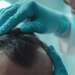 Injerto capilar Barcelona - Médico tricólogo evaluando el cuero cabelludo de un hombre con alopecia en una de las mejores clínicas de injerto capilar Barcelona