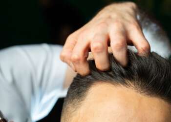 Injerto capilar España - Tricólogo evaluando el cabello de un hombre luego de un implante capilar con los mejores doctores injerto capilar España