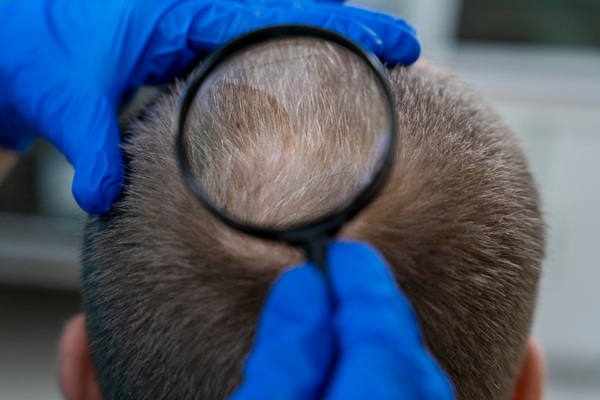 Tricólogo evaluando el cuero cabelludo de un hombre luego de un implante capilar Madrid