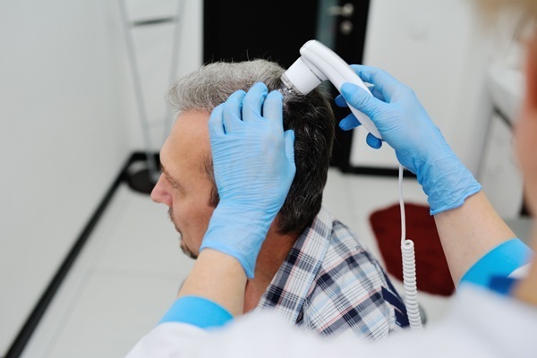 Mejor clínica injerto capilar España - Tricólogo evaluando el cuero cabelludo de un hombre con alopecia para determinar cuánto cuesta un injerto capilar en España