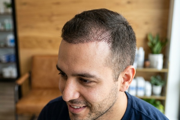 Hombre feliz al notar que comienzan a salir los primeros brotes de cabello trasplantado