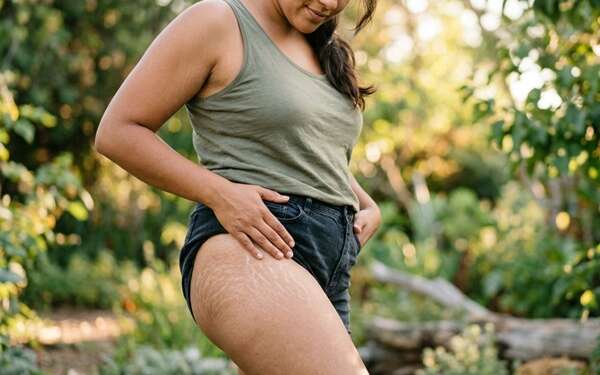 Estrías - Mujer con estrías blancas en las piernas debido al estiramiento de la piel